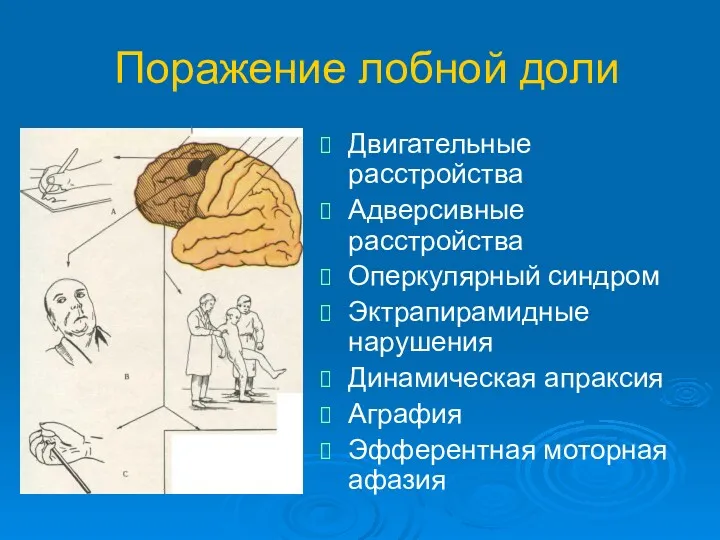 Поражение лобной доли Двигательные расстройства Адверсивные расстройства Оперкулярный синдром Эктрапирамидные