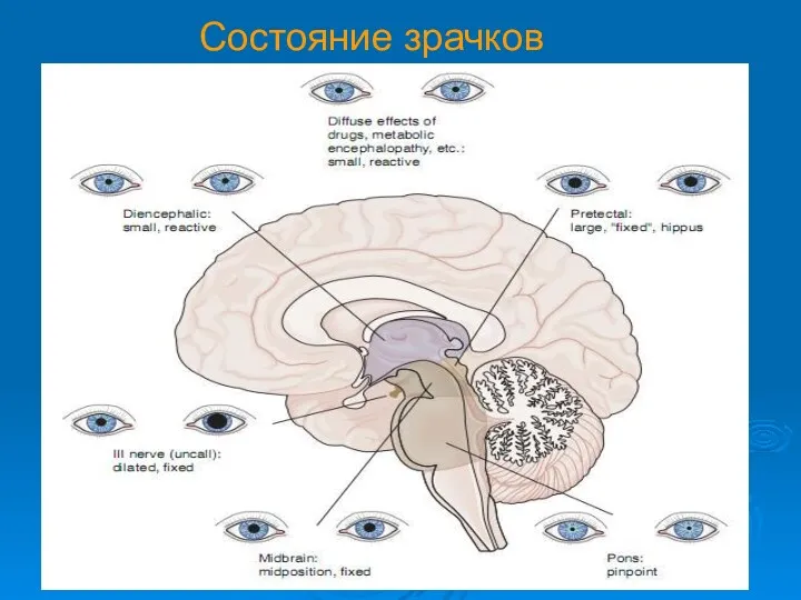 Состояние зрачков