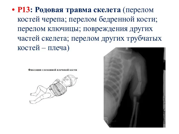 Р13: Родовая травма скелета (перелом костей черепа; перелом бедренной кости;
