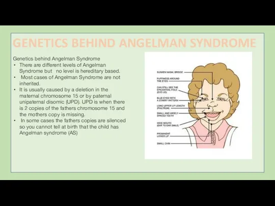 Genetics behind Angelman Syndrome There are different levels of Angelman