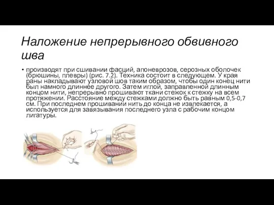 Наложение непрерывного обвивного шва производят при сшивании фасций, апоневрозов, серозных