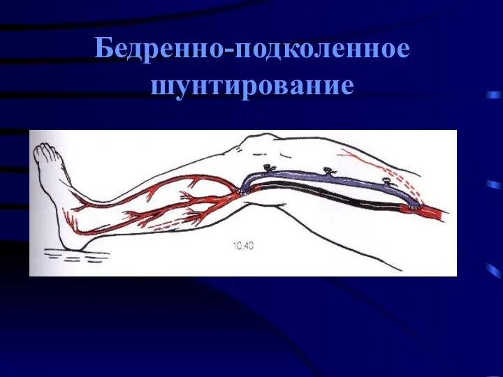 Бедренно-подколенное шунтирование