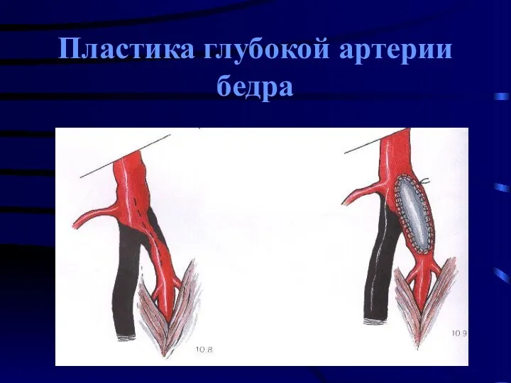 Пластика глубокой артерии бедра