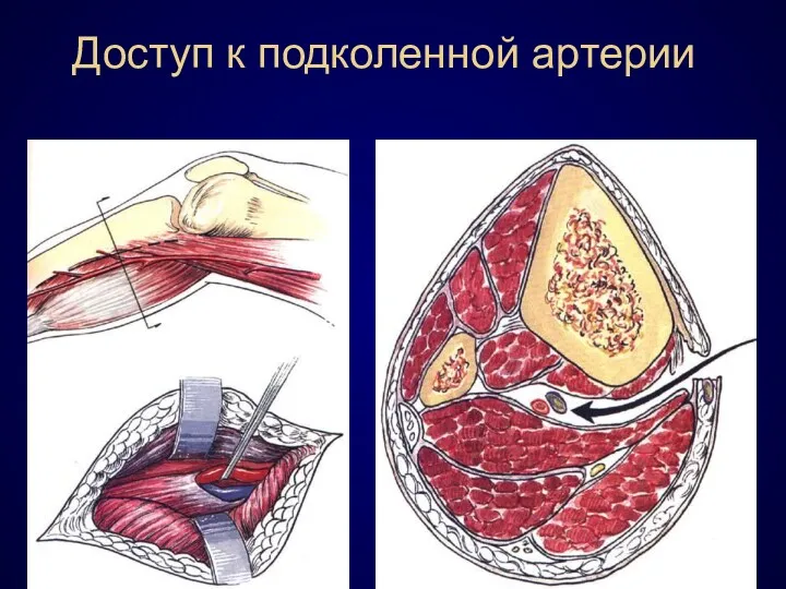 Доступ к подколенной артерии