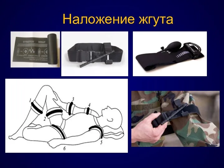 Наложение жгута