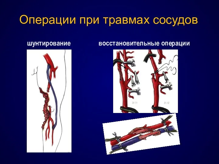 шунтирование восстановительные операции Операции при травмах сосудов