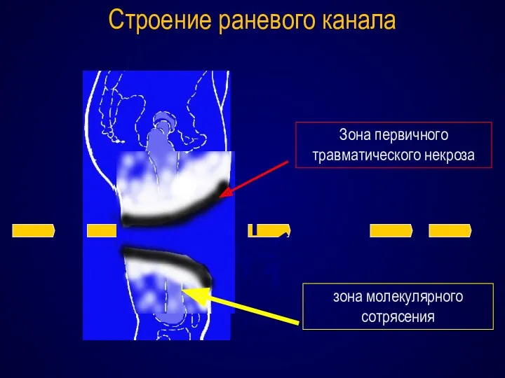 Зона первичного травматического некроза зона молекулярного сотрясения Строение раневого канала