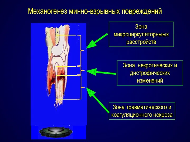 Механогенез минно-взрывных повреждений