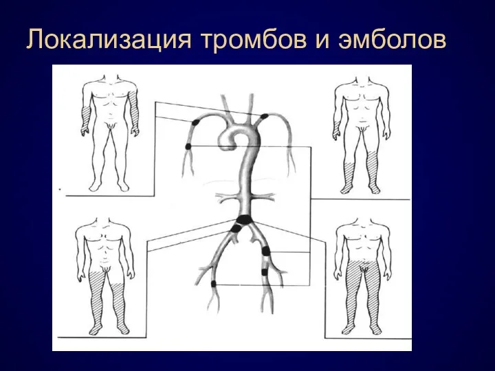 Локализация тромбов и эмболов