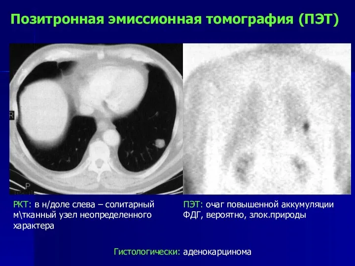Позитронная эмиссионная томография (ПЭТ) РКТ: в н/доле слева – солитарный