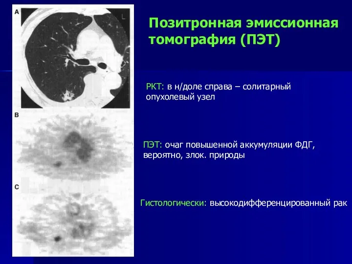 Позитронная эмиссионная томография (ПЭТ) Гистологически: высокодифференцированный рак ПЭТ: очаг повышенной