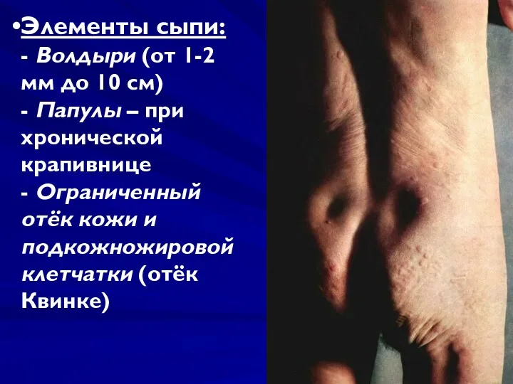 Элементы сыпи: - Волдыри (от 1-2 мм до 10 см)