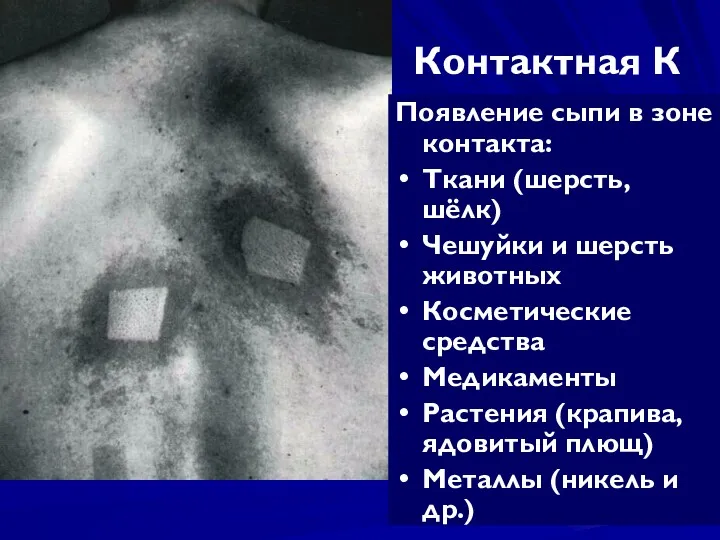 Контактная К Появление сыпи в зоне контакта: Ткани (шерсть, шёлк)