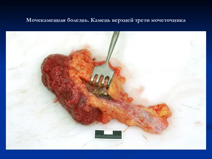 Мочекаменная болезнь. Камень верхней трети мочеточника