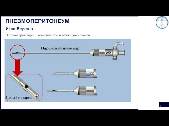 Пневмоперитонеум – введение газа в брюшную полость ПНЕВМОПЕРИТОНЕУМ Наружный цилиндр Полый мандрен Игла Вереша