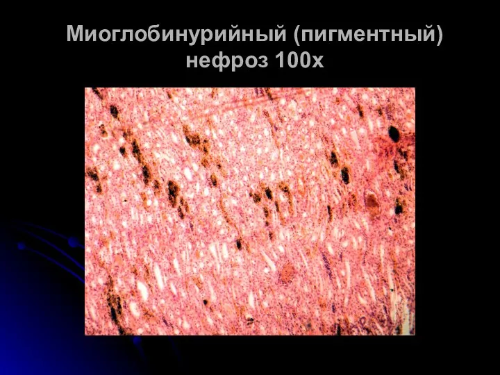 Миоглобинурийный (пигментный) нефроз 100х