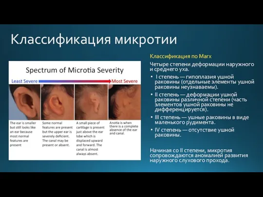 Классификация микротии Классификация по Marx Четыре степени деформации наружного и