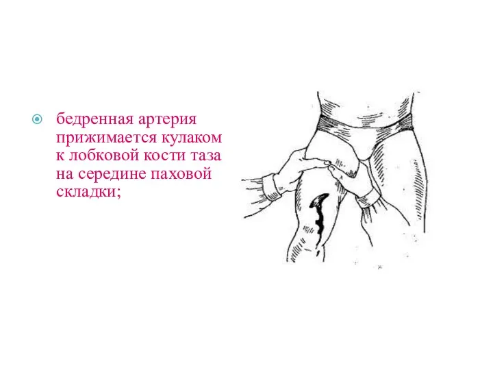 бедренная артерия прижимается кулаком к лобковой кости таза на середине паховой складки;