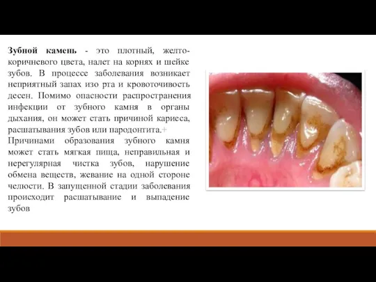 Зубной камень - это плотный, желто-коричневого цвета, налет на корнях