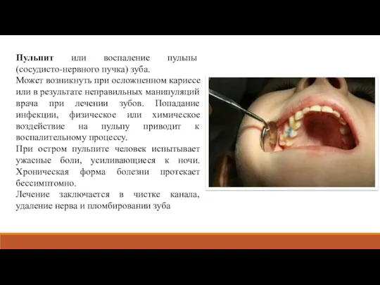 Пульпит или воспаление пульпы (сосудисто-нервного пучка) зуба. Может возникнуть при