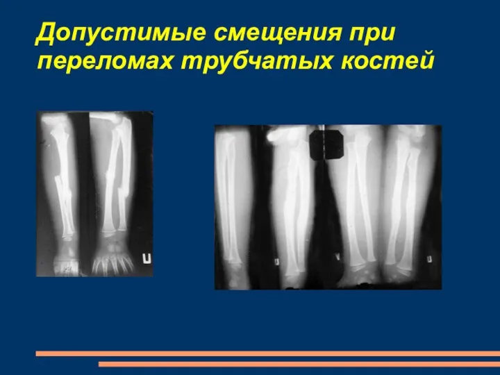 Допустимые смещения при переломах трубчатых костей