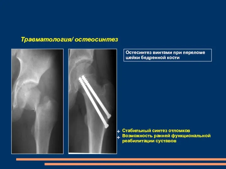 Травматология/ остеосинтез Остесинтез винтами при переломе шейки бедренной кости Стабильный