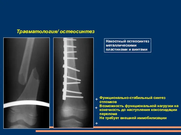 Травматология/ остеосинтез Накостный остеосинтез металлическими пластинами и винтами Функционально-стабильный синтез