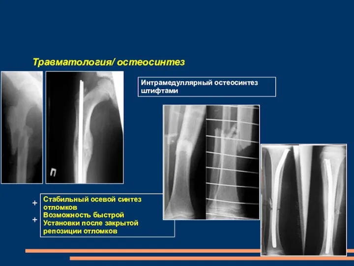 Травматология/ остеосинтез Интрамедуллярный остеосинтез штифтами Стабильный осевой синтез отломков Возможность быстрой Установки после закрытой репозиции отломков