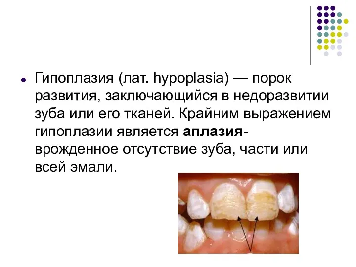 Гипоплазия (лат. hypoplasia) — порок развития, заключающийся в недоразвитии зуба