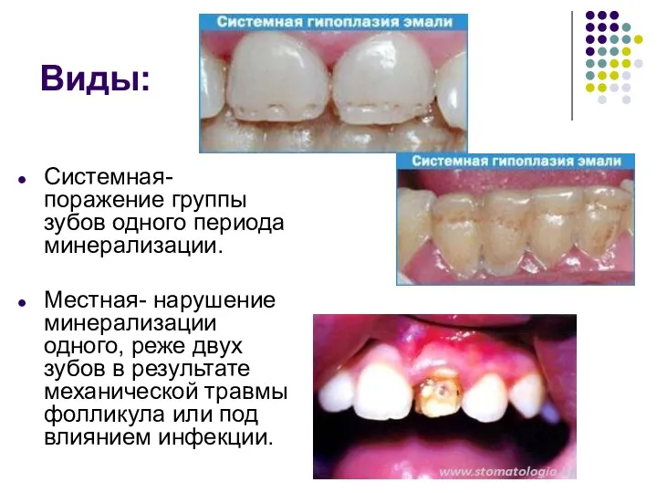 Виды: Системная- поражение группы зубов одного периода минерализации. Местная- нарушение