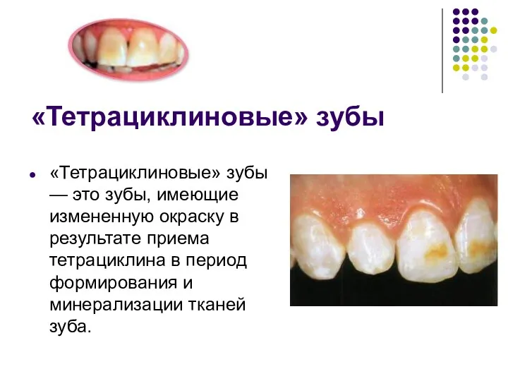 «Тетрациклиновые» зубы «Тетрациклиновые» зубы — это зубы, имеющие измененную окраску