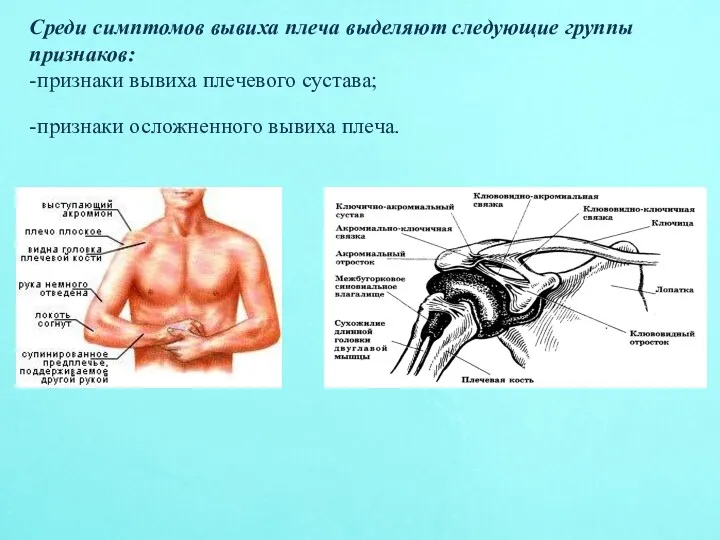 Среди симптомов вывиха плеча выделяют следующие группы признаков: -признаки вывиха плечевого сустава; -признаки осложненного вывиха плеча.
