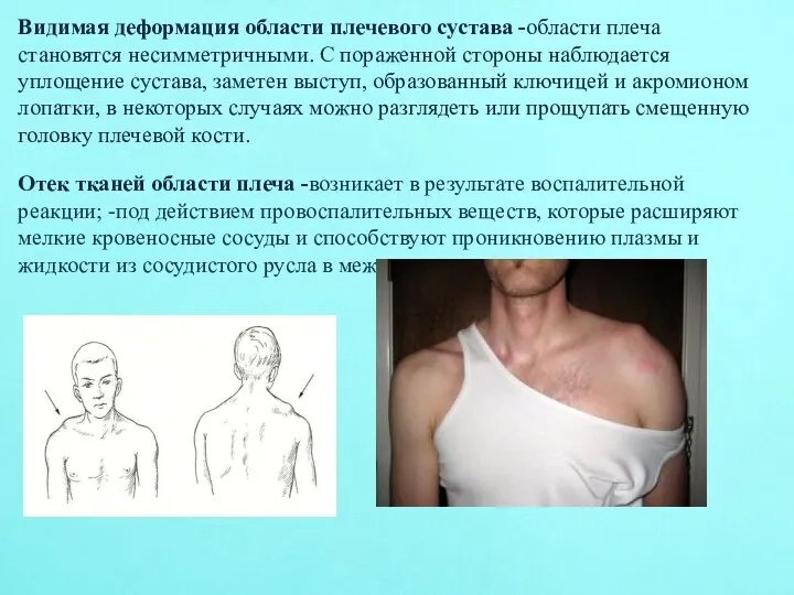 Видимая деформация области плечевого сустава -области плеча становятся несимметричными. С