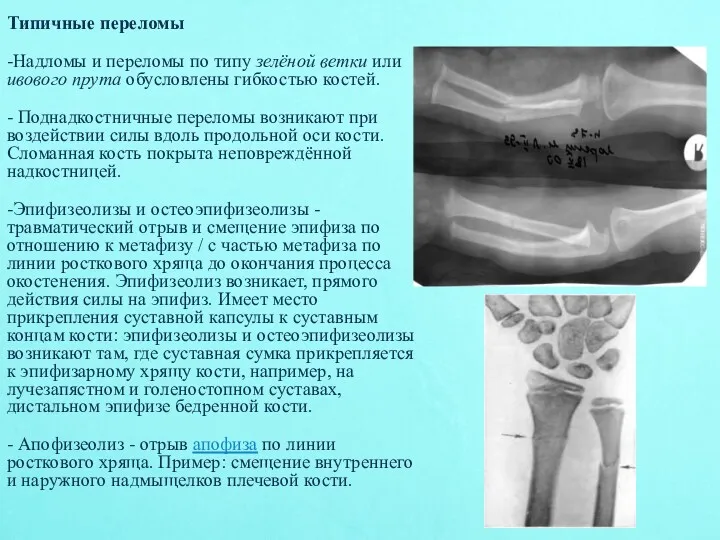 Типичные переломы -Надломы и переломы по типу зелёной ветки или