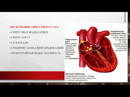 ДИСФУНКЦИЯ СИНУСОВОГО УЗЛА: • СИНУСОВАЯ БРАДИКАРДИЯ • СИНУС-АРЕСТ • СА