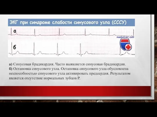 а) Синусовая брадикардия. Часто выявляется синусовая брадикардия. б) Остановка синусового