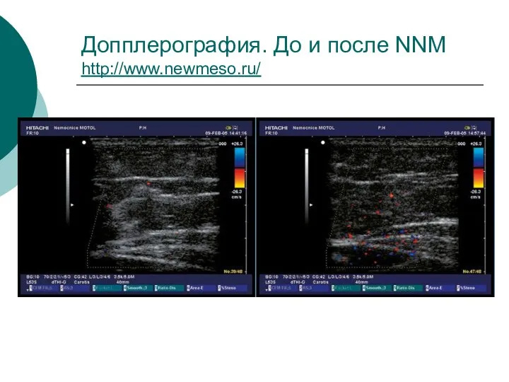 Допплерография. До и после NNM http://www.newmeso.ru/