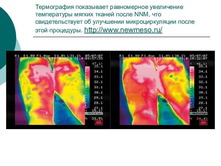 Термография показывает равномерное увеличение температуры мягких тканей после NNM, что