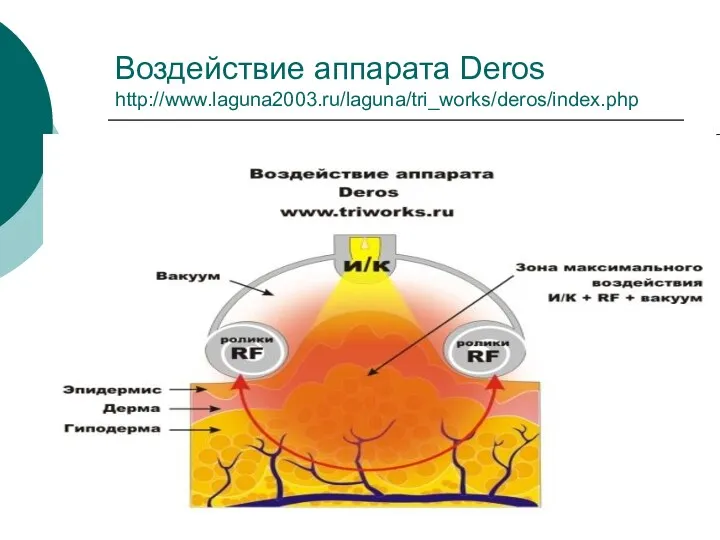 Воздействие аппарата Deros http://www.laguna2003.ru/laguna/tri_works/deros/index.php
