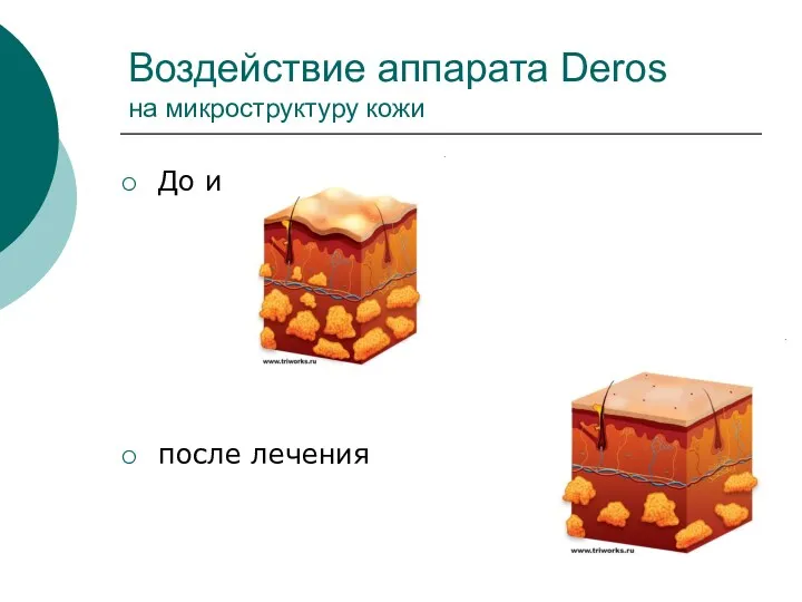 Воздействие аппарата Deros на микроструктуру кожи До и после лечения