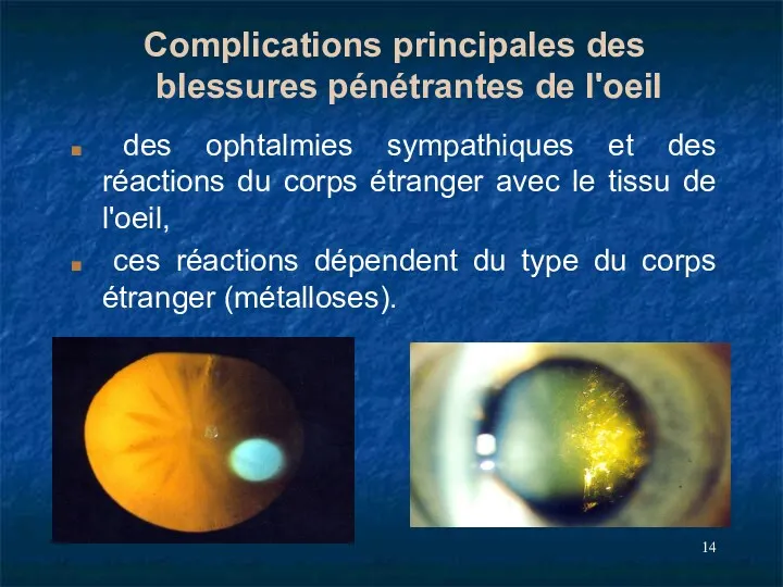 Complications principales des blessures pénétrantes de l'oeil des ophtalmies sympathiques