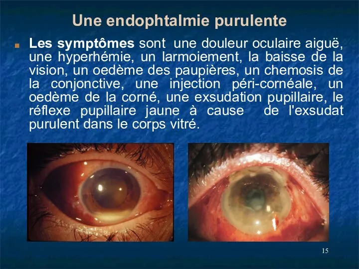 Une endophtalmie purulente Les symptômes sont une douleur oculaire aiguë,