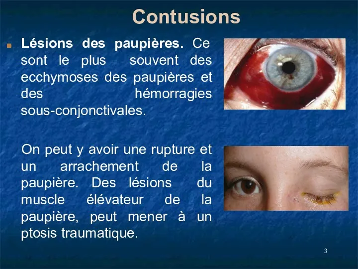 Lésions des paupières. Ce sont le plus souvent des ecchymoses