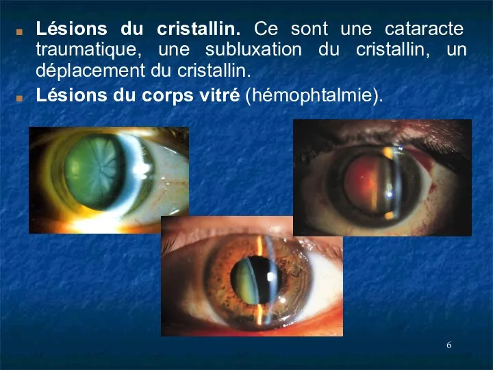 Lésions du cristallin. Ce sont une cataracte traumatique, une subluxation