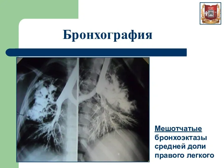 Бронхография Мешотчатые бронхоэктазы средней доли правого легкого