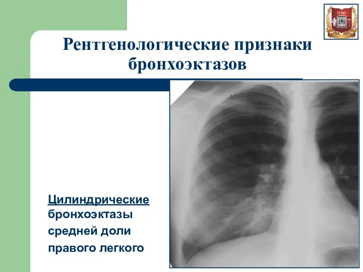 Рентгенологические признаки бронхоэктазов Цилиндрические бронхоэктазы средней доли правого легкого