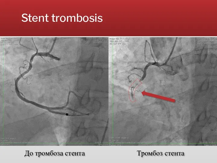 Stent trombosis До тромбоза стента Тромбоз стента
