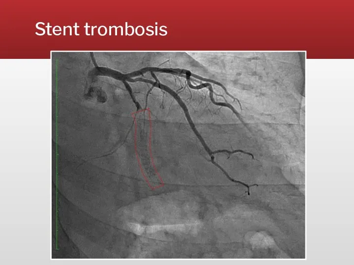 Stent trombosis