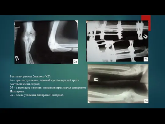 Рентгенограммы больного У.У.: 2а – при поступлении, ложный сустав верхней