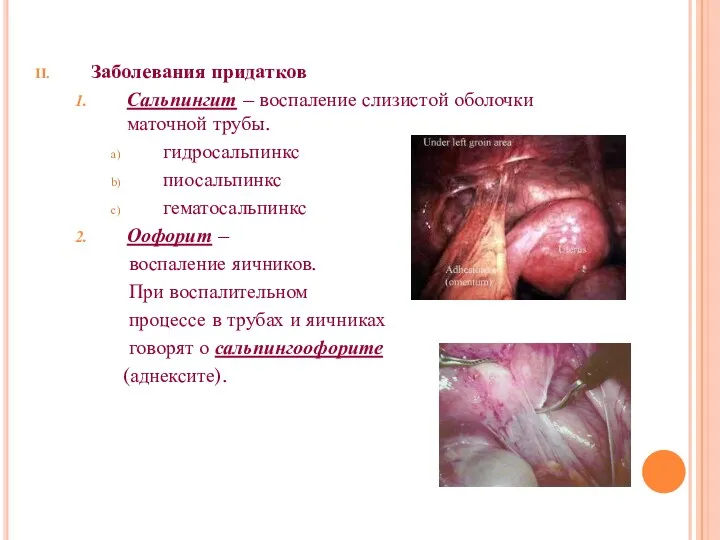 Заболевания придатков Сальпингит – воспаление слизистой оболочки маточной трубы. гидросальпинкс